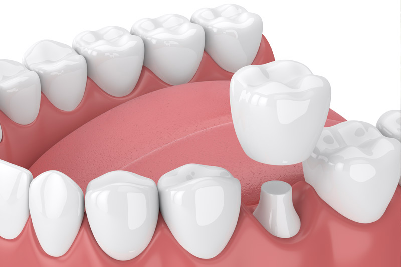 Dental Crowns in Snohomish