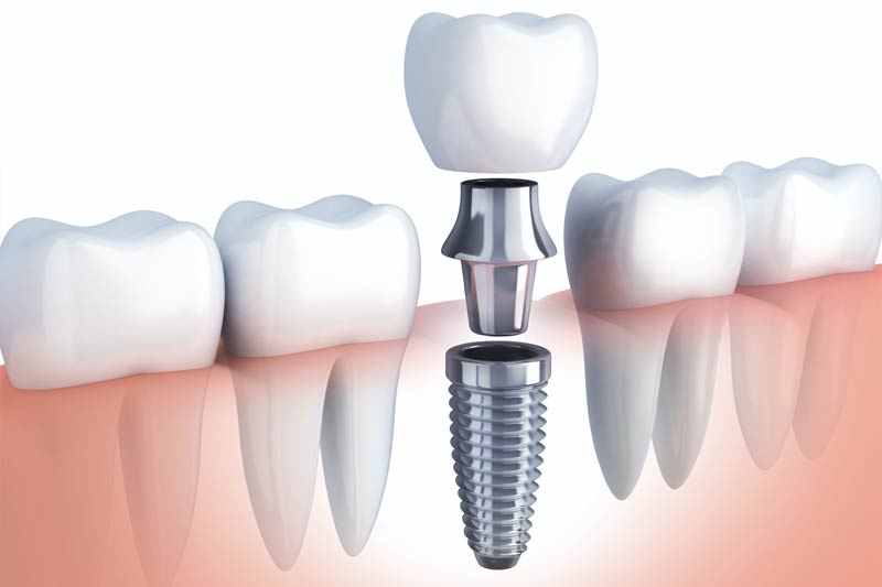 Implants Dentist in Snohomish