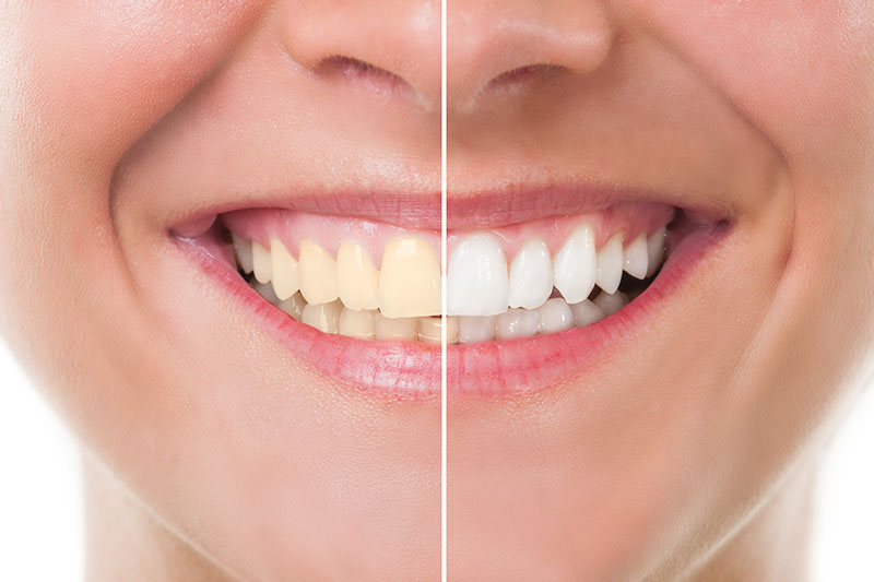 Teeth Whitening in Snohomish